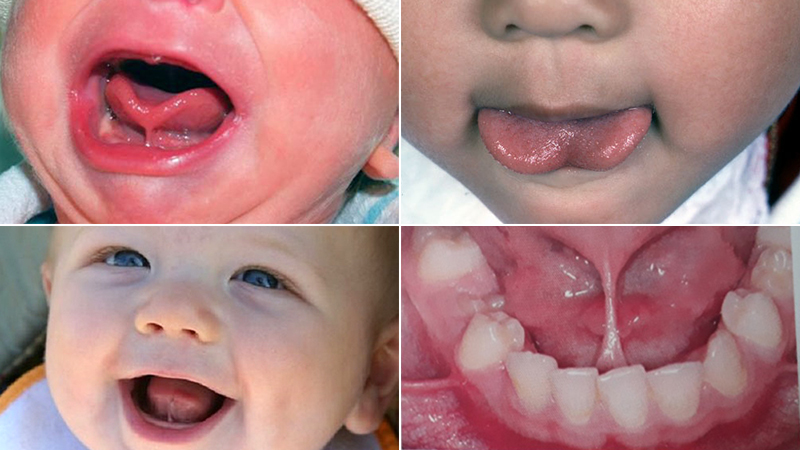 Điều trị cắt phanh lưỡi cho trẻ nhỏ - Nha Khoa Thùy Anh Thái nguyên